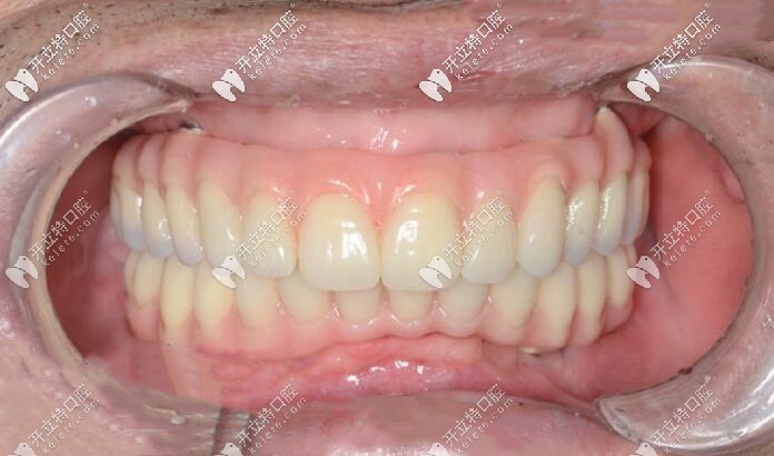 北京維嘉口腔全口種植牙術(shù)后照片
