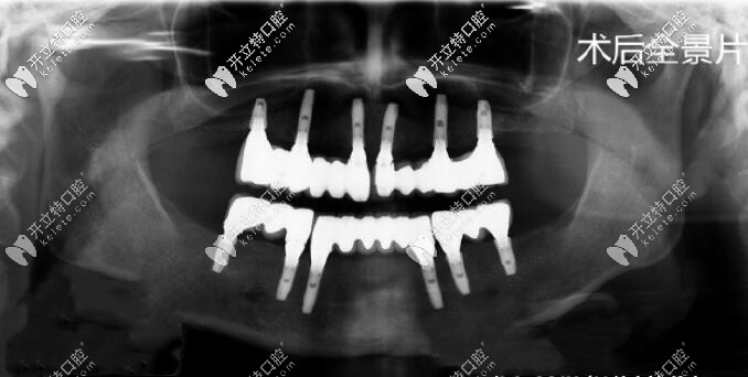 請問北京維嘉口腔怎么樣?想做全口種植牙去這家牙科靠譜嗎