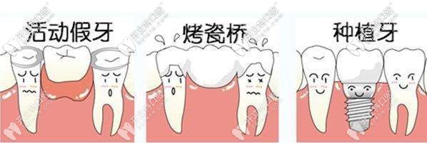 鑲牙分為活動假牙、烤瓷牙及種植牙