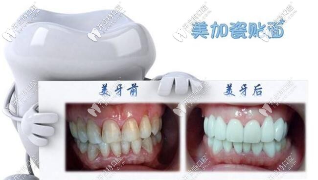 美加超薄瓷貼面