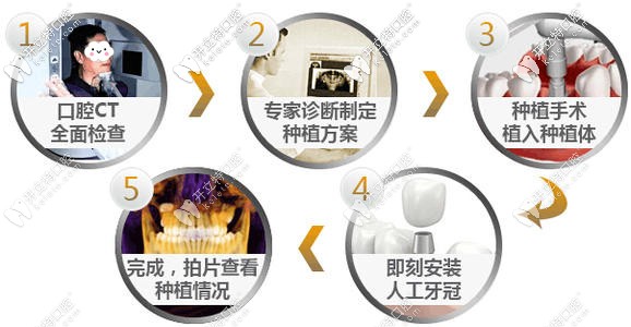種植牙的過(guò)程