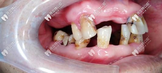術(shù)前的牙齒缺失情況