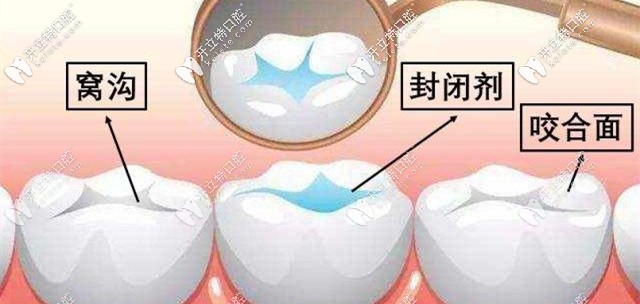 窩溝封閉可以有效預(yù)防齲齒