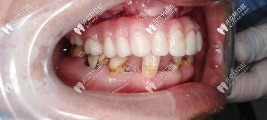 術(shù)后種植牙后的側(cè)面