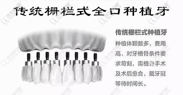 傳統(tǒng)柵欄式全口種植牙