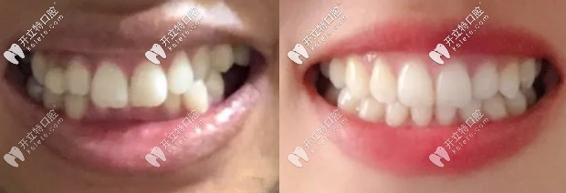 40歲矯正牙齒經(jīng)歷:重度深覆合摘下自鎖牙套后笑起來很迷人