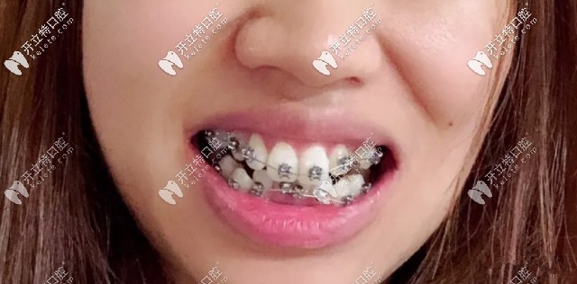 剛帶上牙套的時(shí)候