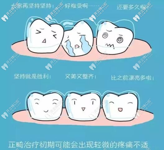 牙齒矯正戴牙套為什么會疼痛