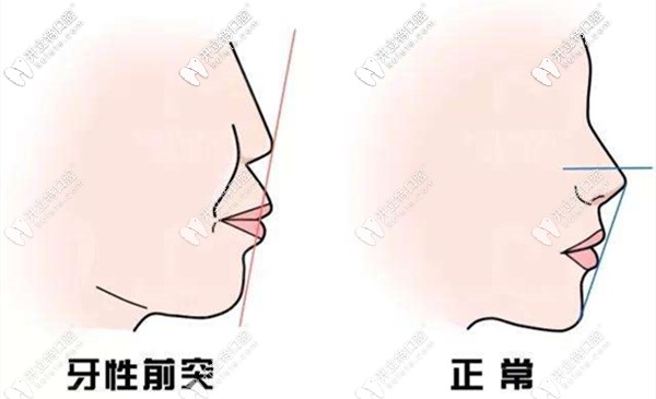 看到許多人在整牙后改變了側(cè)貌