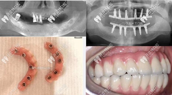 沈陽(yáng)米蘭口腔全口種植牙案例
