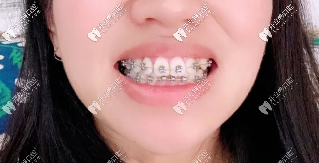 快該摘掉牙套啦，牙齒已經(jīng)排齊了