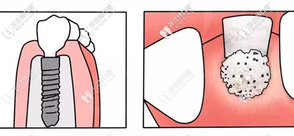 延期種植的介紹