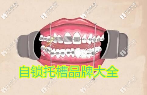 金屬自鎖牙套品牌大全匯總,說說國產(chǎn)和進(jìn)口到底有啥區(qū)別？