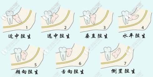 各類智齒的種類