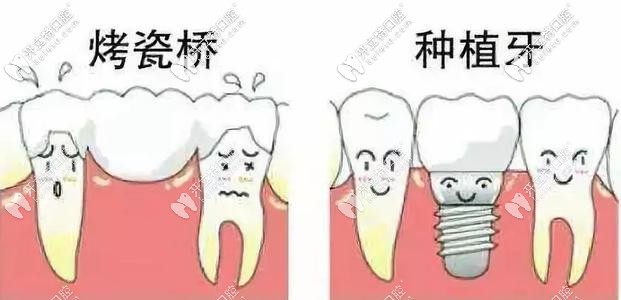 烤瓷牙和種植牙對(duì)比