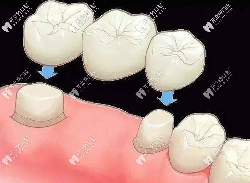 連橋冠修復(fù)