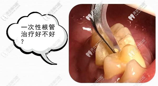 有關(guān)一次性根管治療步驟和適應(yīng)癥你知多少？