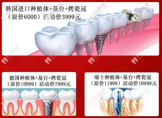 蘭州韓美齒科種植牙價(jià)格