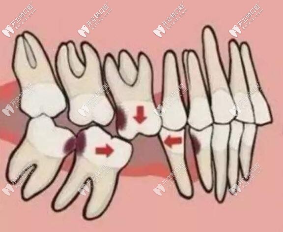 牙齒缺失不修復(fù)的危害