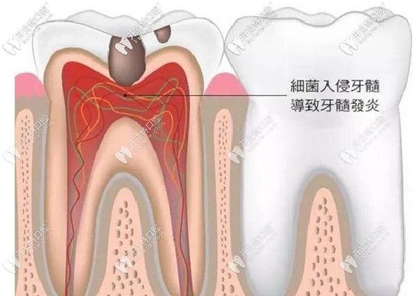 一次性根管治療的適應(yīng)癥有哪些
