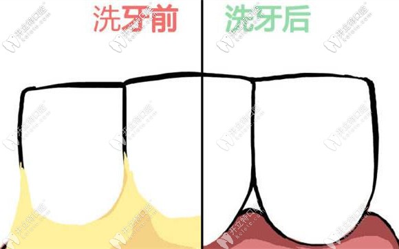 要定期進行洗牙