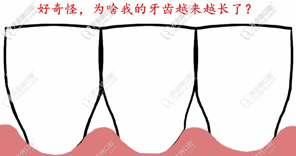 醫(yī)生，為什么我感覺牙齒越來越長了？