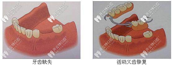 活動義齒修復(fù)