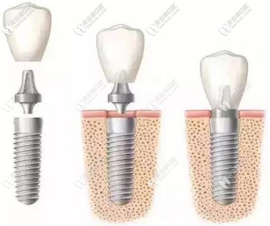 不看不知道,原來(lái)奧齒泰種植體竟然也有一段式和二段式之分