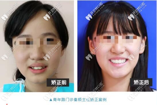 武漢愛(ài)尚大眾口腔正畸案例