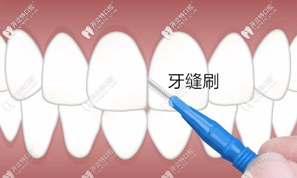 需要多種方法聯(lián)合清潔牙齒