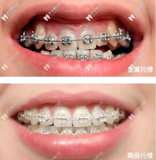 金屬托槽和陶瓷托槽圖片