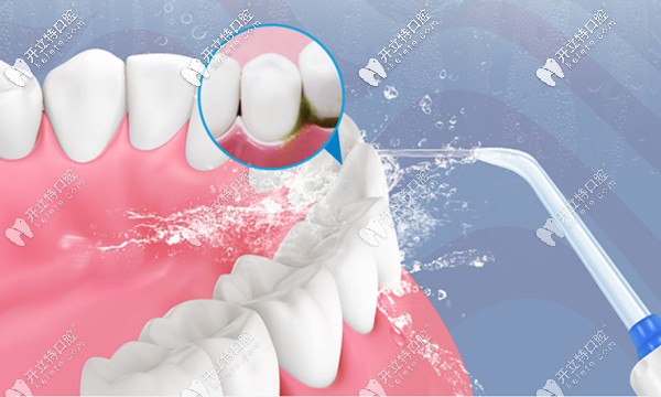 牙周炎的治療方法