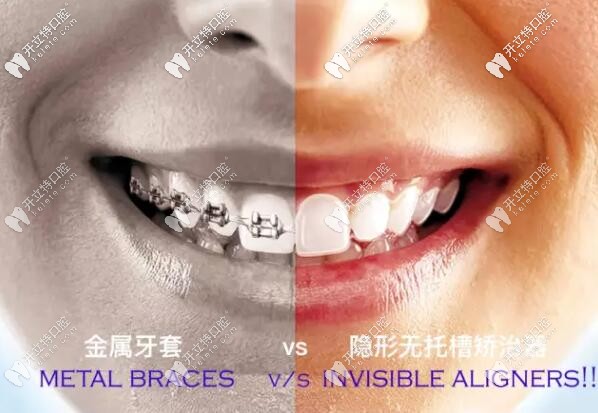 金屬托槽和隱形無托槽牙套圖片