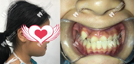葫蘆島寶媽如果你家兒童牙齒反頜確定不看看這個矯治案例?