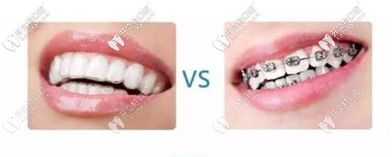 傳統(tǒng)牙套和隱形矯正對比