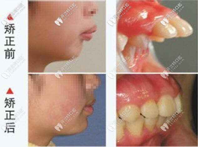 金屬托槽矯正前后對比圖