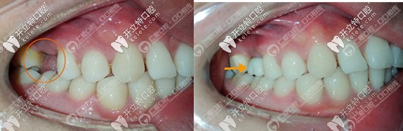 案例集:原來有挺多年輕人種價(jià)格便宜的登騰和奧齒泰種植牙