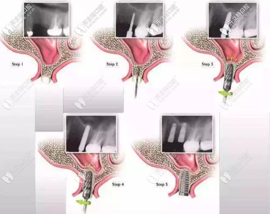 上頜竇提升手術(shù)的全過(guò)程