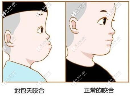 地包天和正常咬合圖片