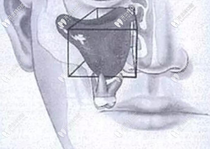 種植牙上頜竇穿透了會(huì)自愈嗎