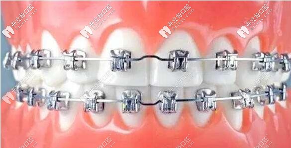 鋼牙套托槽矯正器