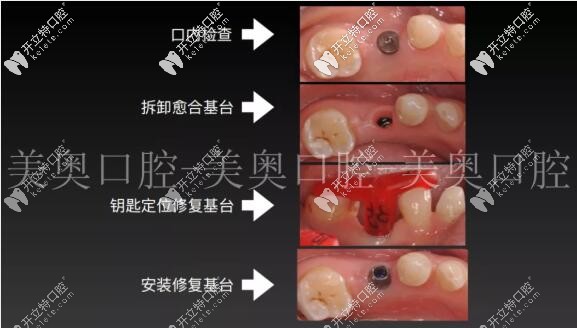 種植牙術后拆卸基臺