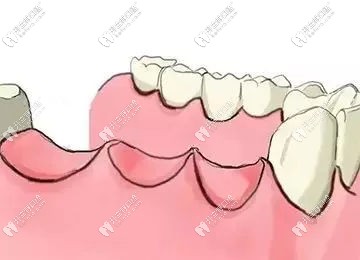 多顆缺牙種植活動(dòng)