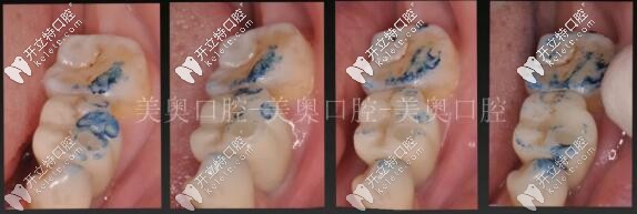無錫美奧種植牙調(diào)頜