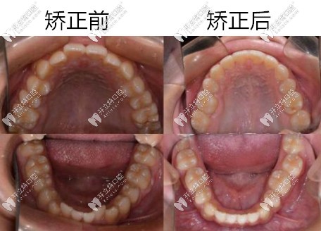  昆明美奧正畸案例前后對(duì)比圖