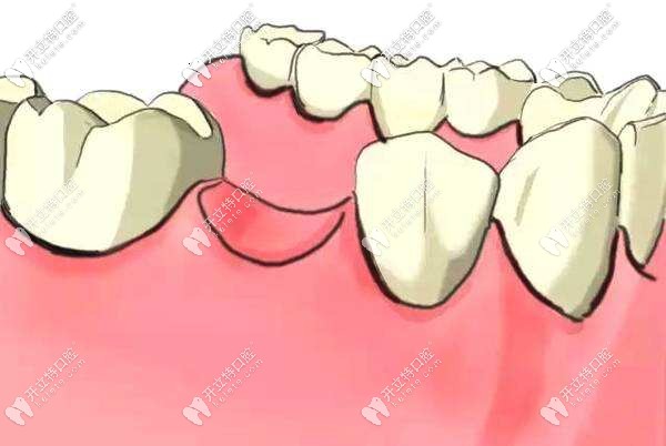 單顆缺牙活動(dòng)