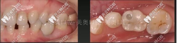 單顆種植牙圖片