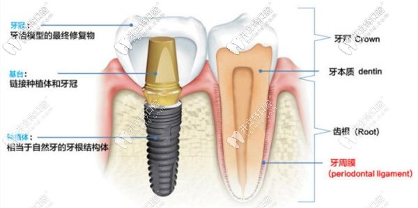 劉果生做一顆種植牙只用十多分鐘 劉果生做一顆種植牙只用十多分鐘