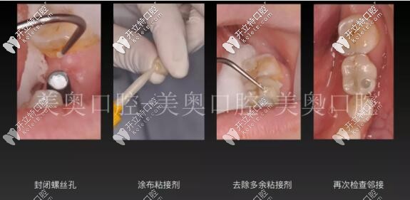 無錫美奧口腔單顆牙冠佩戴