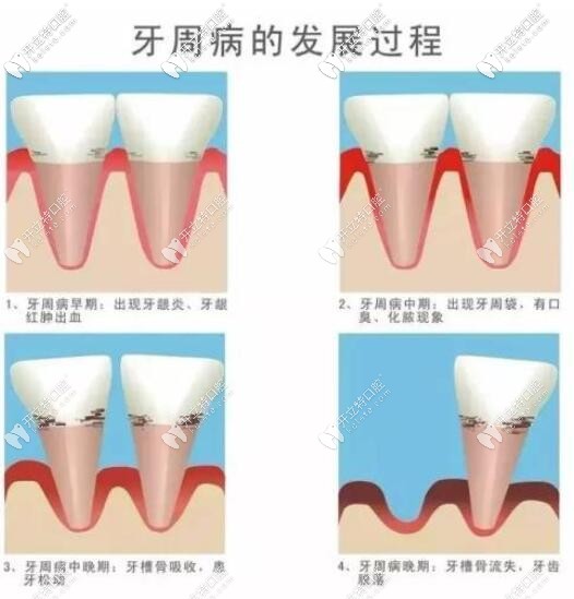 牙周病的發(fā)展過(guò)程